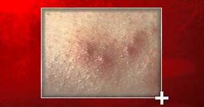 Signs of Bed Bug Bites - Health Checks