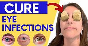 How to Treat Eye Infections, Eye Allergies and Pink Eye Naturally at Home