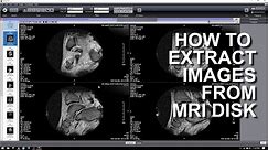 HOW TO EXTRACT IMAGES FROM A MRI DICOM DISK
