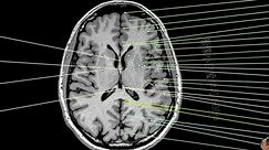 1.颅脑MRI解剖图谱-端脑MRI解剖