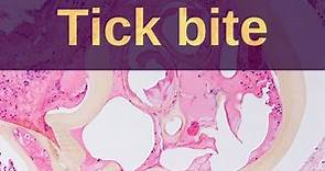 Tick Bites - Pathology mini tutorial