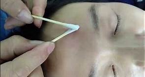 中醫針灸美容瘦臉針08 手法操作及解剖