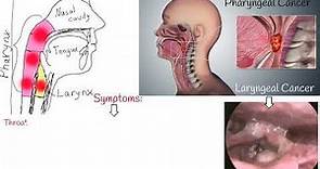 Throat cancer - Symptoms, causes and Treatment. Laryngeal Cancer and Pharyngeal Cancer