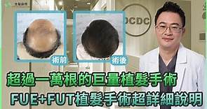 超過一萬根的巨量植髮手術，FUE+FUT植髮手術超詳細說明｜生髮植髮專家朱冠州院長
