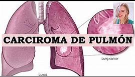 CÁNCER DE PULMÓN: TIPOS (MICROCÍTICO Y NO MICROCÍTICO), FISIOPATO, SÍNTOMAS, ESTADÍOS Y TRATAMIENTO