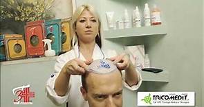 Impianto protesi capelli uomo - Tricomedit