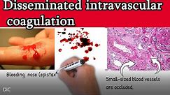 Disseminated intravascular coagulation (DIC) - Causes, Symptoms, Treatment and prognosis