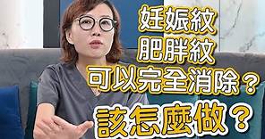 想要消除妊娠紋、肥胖紋嗎？莊盈彥醫師告訴你如何預防及治療妊娠紋！