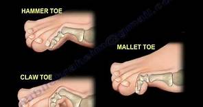 Toe Deformities Hammer, Claw & Mallet Toes - Everything You Need To Know - Dr. Nabil Ebraheim