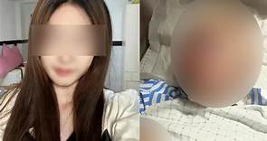 20歲網紅上廁所被埋伏攻擊 臉部骨折掉7顆牙恐毀容｜東森新聞