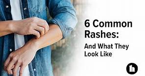 6 Common Rashes: And What They Look Like | Healthline