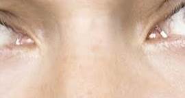 Hazel Eyes or Central Heterochromia?