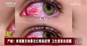 [今日亚洲]速览 严峻！柬埔寨多地暴发红眼病疫情 卫生部紧急提醒