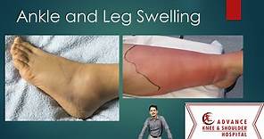 Top 10 causes of Ankle and Leg Swelling