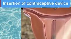 Inserting a contraceptive device. #contraception #contraceptive #mirena #menstruation #pregnancy #hormonebalance #sciencefacts #sciencefiction #scienceeducation #mbbs #mbchb #education #medicaleducation #doctorsofinstagram #doctor #medicalstudent #nurse #studentnurse #physician #physicianassistant #physicianassociate #paramedics #paramedicstudent #usmle #plab #NHS #midwife #studentmidwife | Dr Mivy Singh