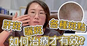 肝斑、色素不均是如何造成？來看看莊盈彥醫師治療肝斑的方式有哪些！