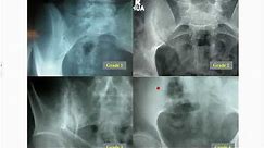 The Diagnosis and Management of Axial Spondyloarthritis