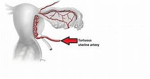 Mastering Uterine Artery Anatomy: A Concise Summary Included