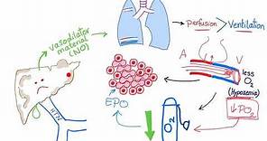 Hepatopulmonary syndrome