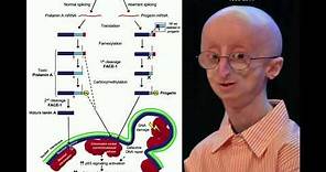 Progeria, Accelerated Aging | Biochemical Mechanism of Progeria