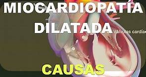 Causas de la miocardiopatía dilatada
