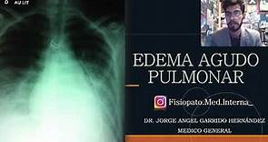 Dr. Garrido. EDEMA AGUDO PULMONAR PARTE 1/Definición, fisiopatología, clínica, diagnostico.