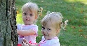 Conjoined Twins Learn to Live Apart