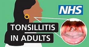 Tonsillitis in adults: Symptoms and treatment | NHS