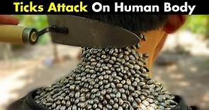 Ticks Bites On Human | Symptoms, Causes And Treatment