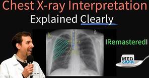 Chest X Ray Interpretation Explained Clearly - How to read a chest Xray