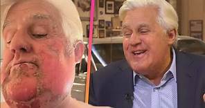 Jay Leno Says His Face Caught Fire in First Interview After Burn Accident