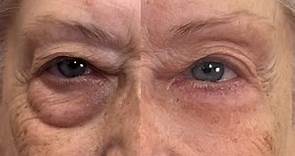 Get Rid of Eye Bags Instantly (Eliminate Puffiness and Darkness) 🚨 Fierce Aging with Nikol Johnson