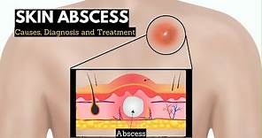 Skin Abscess, Causes, Signs and Symptoms, Diagnosis and Treatment.