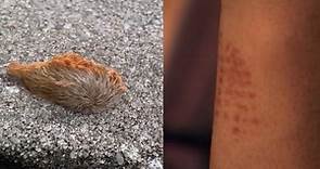 Venomous puss caterpillars in Florida: What to do if you get stung
