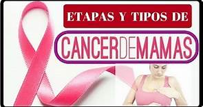 Etapas Del Cancer De Mamas | Tipos De Cancer De Mamas | CANCER DE MAMAS |Salud De Hoy - radioterapia