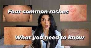 Four common rashes and everything you need to know about them!