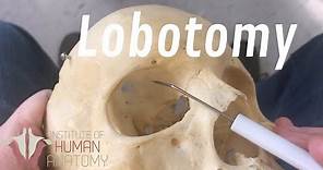 The Anatomy of a Lobotomy