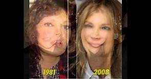 Jacqueline Smith plastic surgery before and after photos
