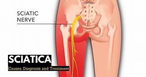 Sciatica, Causes, Signs and Symptoms, Diagnosis and Treatment