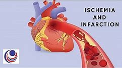 Ischemia and Infarction: The difference and Similarities