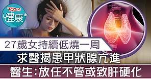 【甲亢危機】27歲女持續低燒一周揭患甲狀腺亢進　醫生：放任不管或致肝硬化 - 香港經濟日報 - TOPick - 健康 - 醫生診症室