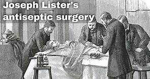 12th August 1865: Joseph Lister conducts the world’s first antiseptic surgery using carbolic acid