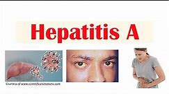 Hepatitis A | Virus, Risk Factors, Pathophysiology, Signs & Symptoms, Diagnosis, Treatment