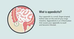 Appendicitis: Symptoms, Causes, Diagnosis, and Treatment | Merck Manual Consumer Version