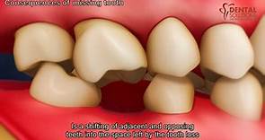 What are the consequences of missing teeth?