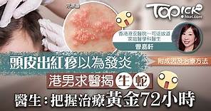 【生蛇】港男頭皮出紅疹揭「生蛇」　醫生：把握治療黃金72小時 - 香港經濟日報 - TOPick - 健康 - 醫生診症室