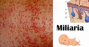 Miliaria (Heat Rash) - Types, Causes, Signs & Symptoms, Complications, And Treatment