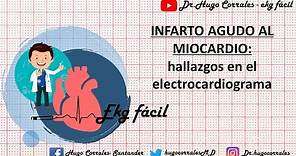 INFARTO AGUDO DE MIOCARDIO: Hallazgos electrocardiográficos.