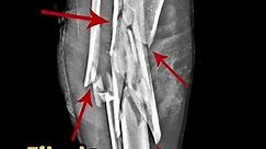 Comminuted Fracture Leg Xray | Trauma #fracture #xray #trauma #radiology