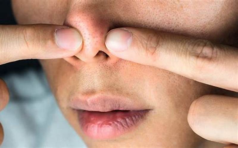  Cara Efektif Mengobati Jerawat Di Dalam Hidung 